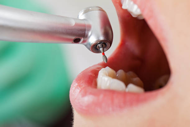 Best Emergency Wisdom Teeth Removal in Hartselle, AL